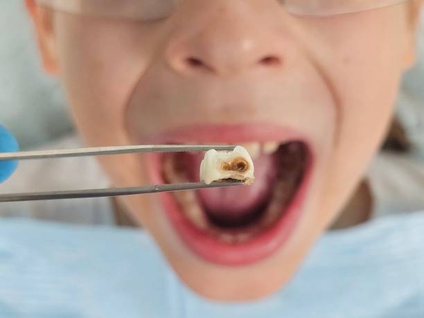 Best Emergency Dental Care for Broken or Chipped Teeth in St Augustine Beach, FL